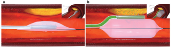 Microneedle balloon catheter