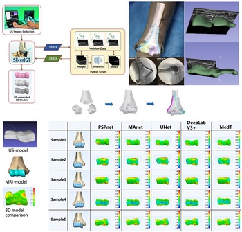 Ultrasound-based navigation system for minimally invasive fracture reduction