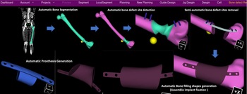 Automated patient-specific prosthesis design system for bone defects