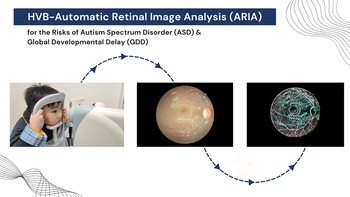 AI retinal image analysis for the risk of Autism (ASD) and GDD in preschoolers